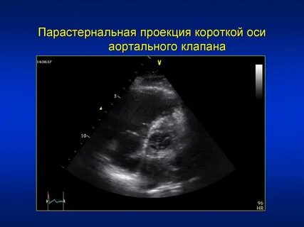 Впс аортального клапана