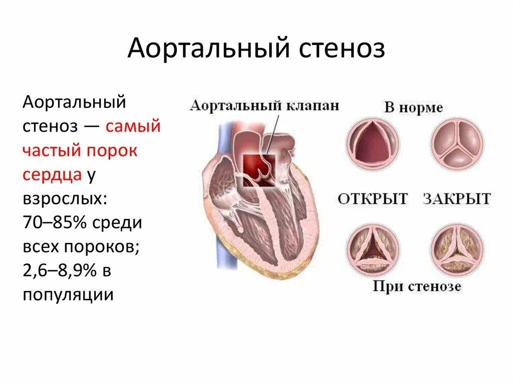 Стеноз сердца что это такое