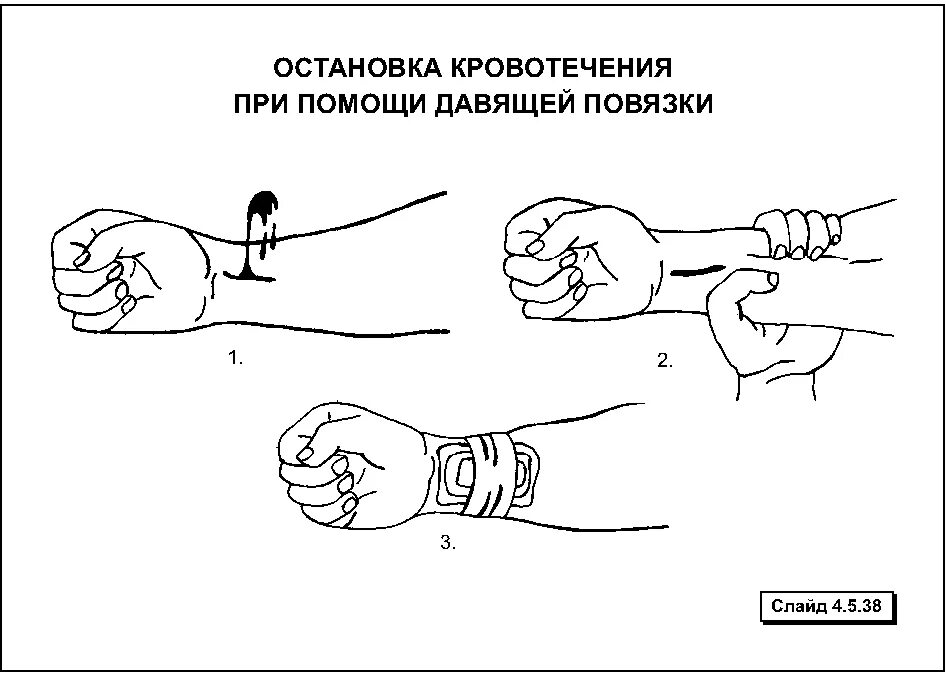 Давящая повязка метод остановки кровотечения. Остановка кровотечения с помощью давящей повязки алгоритм. Остановка кровотечения. Наложение жгута, давящей повязки. Давящая повязка для остановки венозного кровотечения. Останавливать кровотечение путем