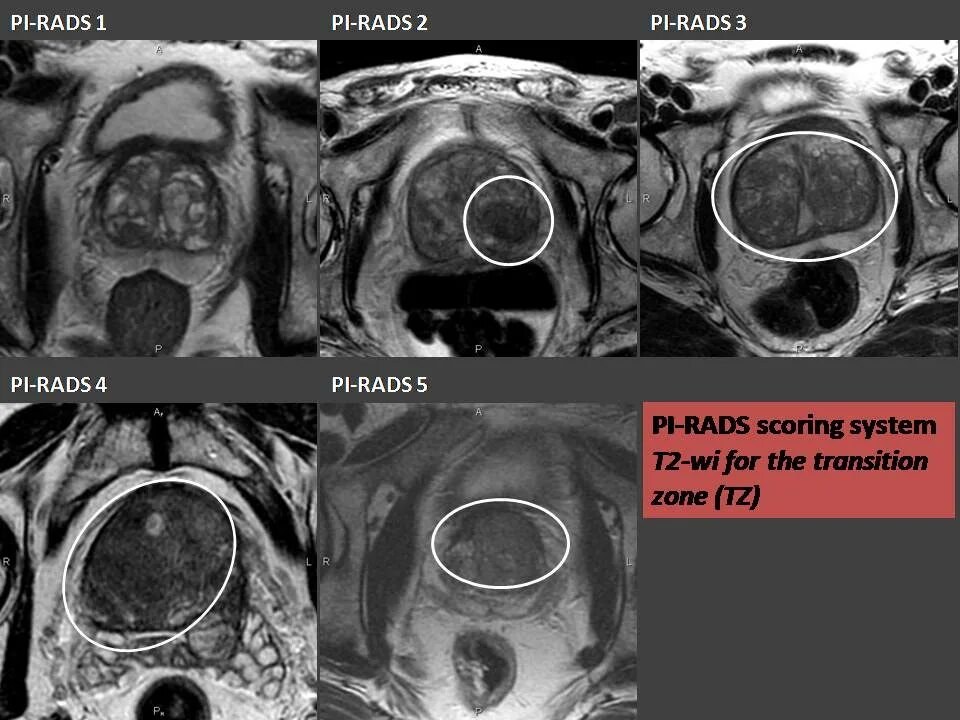 Rads 4 предстательной железы. Предстательная железа Pi rads мрт. Pi-rads 5 предстательной железы.