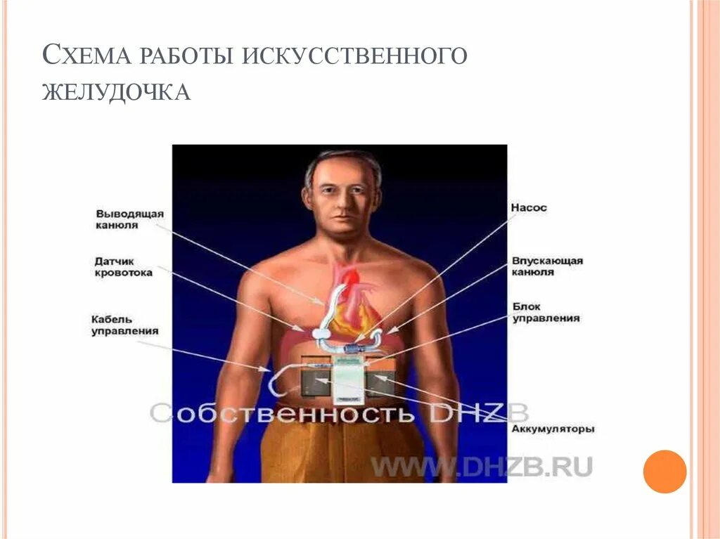 Искусственный желудочек сердца. Искусственный левый желудочек. Искусственный левый желудочек устройство. Имплантация искусственного левого желудочка сердца.