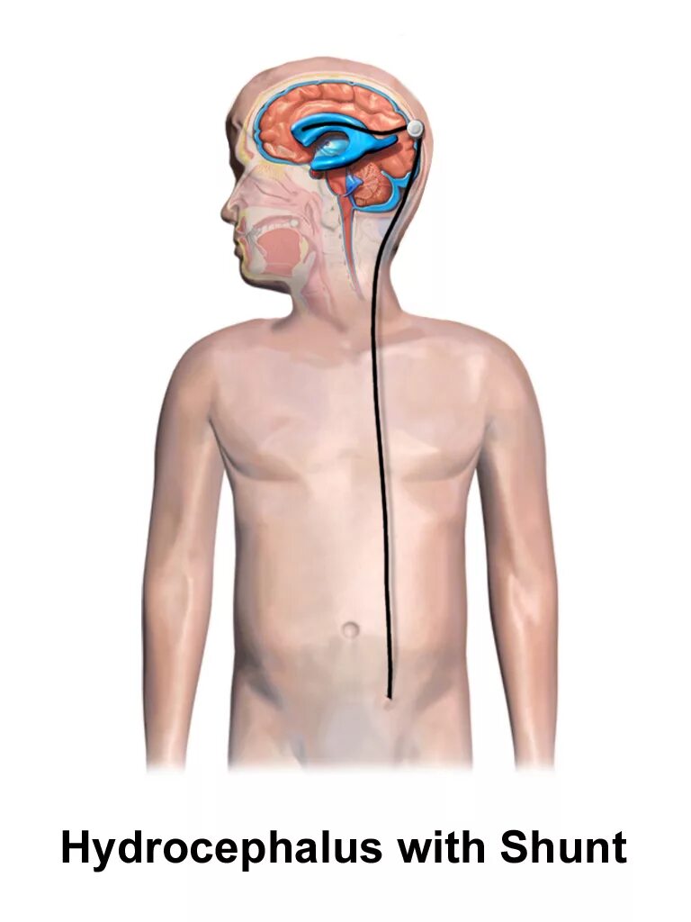 Шунт головного мозга. Шунтирование гидроцефалии головного мозга. Шунтирование при гидроцефалии.
