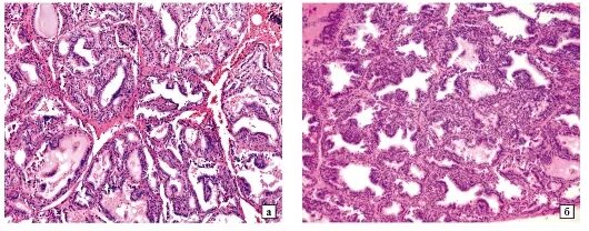 Острый диффузный миокардит патанатомия. Диффузный препарат. Муцинозная аденокарцинома желудка гистология. Интерстициальный гепатит микропрепарат. Коллоидная струма микропрепарат.