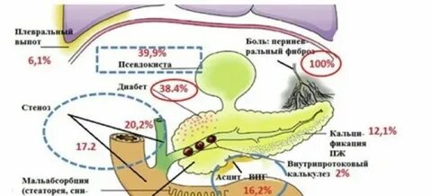 Хронический панкреатит карта