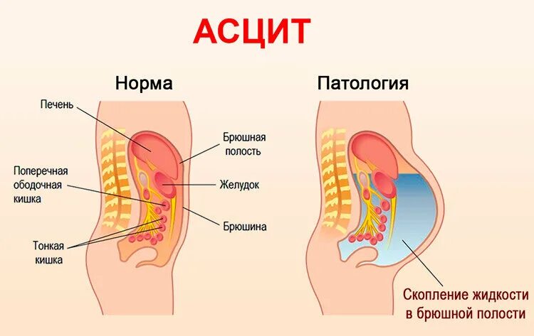 Жидкость в брюшной полости называется