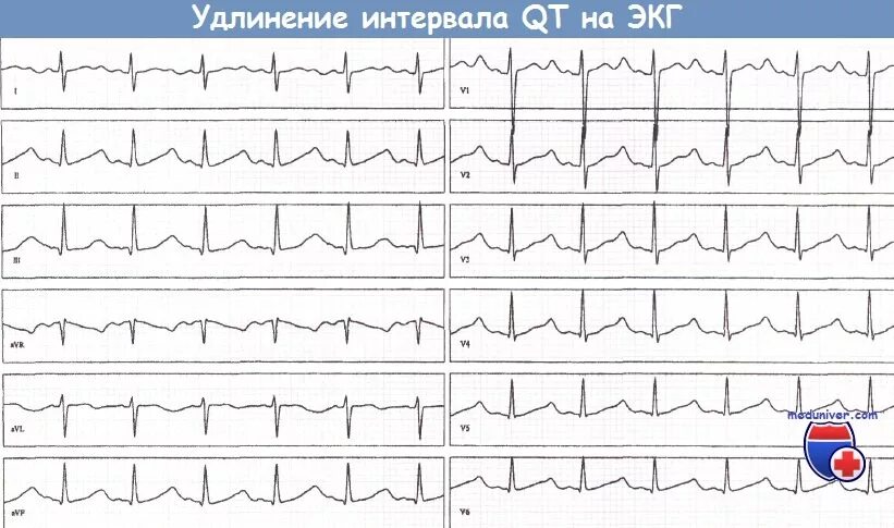 Синдром удлиненного интервала qt на ЭКГ. ЭКГ С синдромом удлиненного интервала qt у детей. Удлиненный интервал qt на ЭКГ что это такое. Удлинённый интервал qt на ЭКГ. Удлиненное qt у ребенка