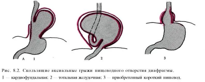 Диафрагмальный пищевода