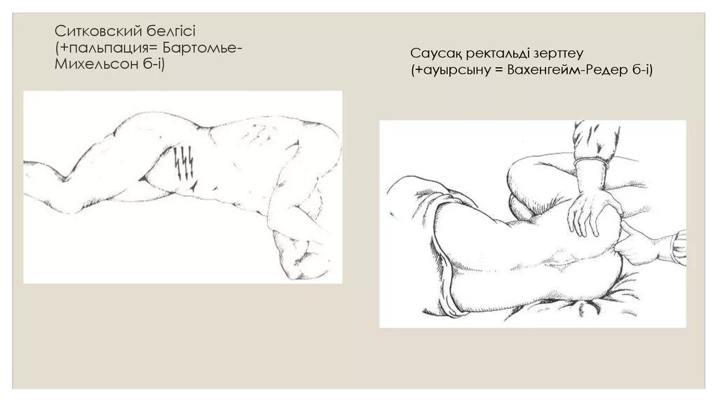 Аппендицит щеткин блюмберг. Симптомы Ровзинга Ситковского Бартомье-Михельсона. Симптом Бартомье Михельсона.