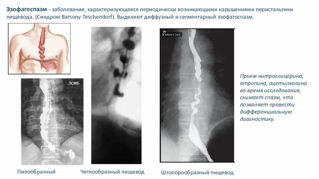 Диффузный эзофагоспазм. Склеродермия пищевода рентген. штопорообразный пищевод рентген. эзофагоспазм патогенез. диффузный спазм пищевода рентген.