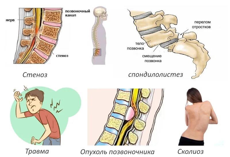 Осложнения травм позвоночника. Травма поясничного отдела. Ушиб поясничного отдела позвоночника.