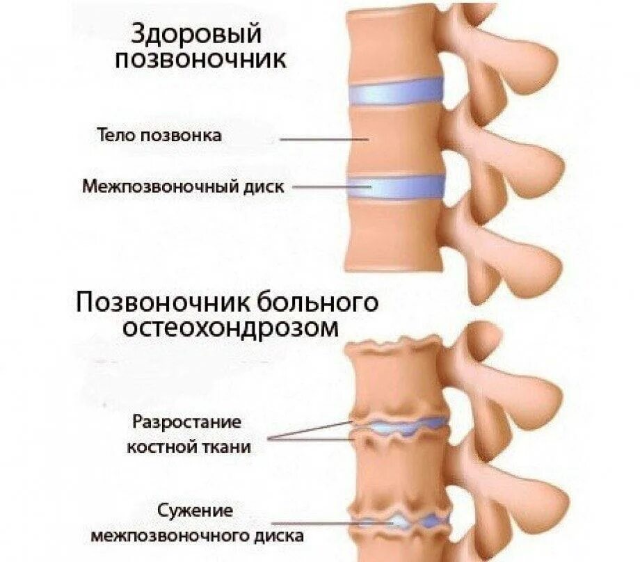 Хондроз шейного отдела позвоночника симптомы. Остеохондроз поясничного отделения позвоночника. Остеохондроз грудного поясничного отдела позвонка. Остеохондроз грудного отдела позвоночника симптомы. Остеохондроз грудного отдела грудной отдел.