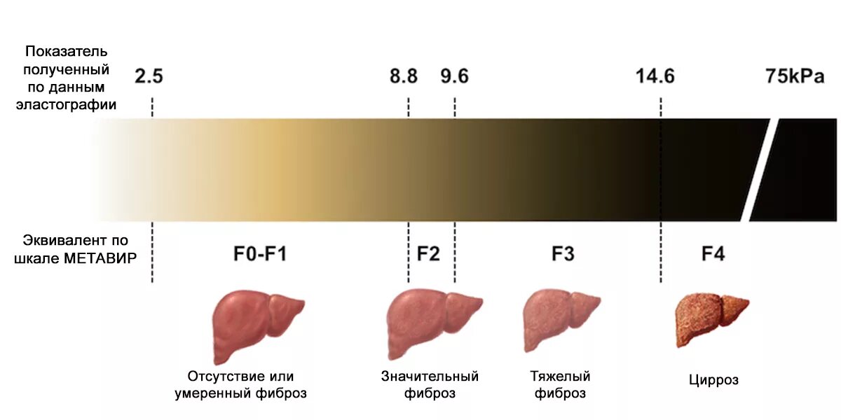 Сколько живут фиброзом 4. Фиброз печени по шкале метавир. Шкала эластографии печени. Цирроз печени шкала метавир. Эластометрия печени f4 по шкале метавир.