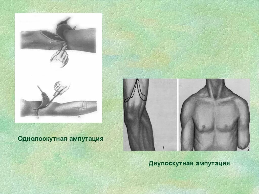 Лоскутная ампутация. Однолосеутная ампутация. Ампутация верхней конечности. Ампутация конечности Оперативная хирургия. Лоскутные ампутации конечностей классификация.