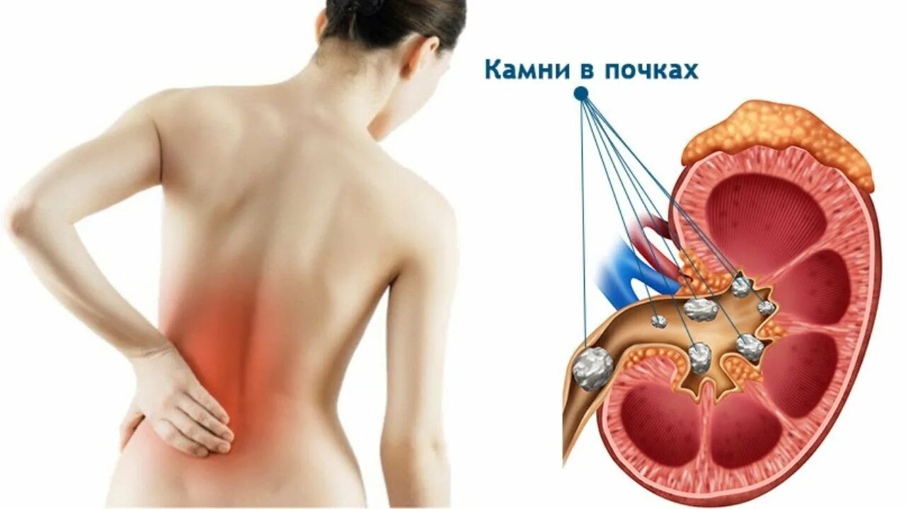 Камни в почках заболевание. Кампив почках симптомы. Камгив почках симптомы. Симптомы камня в почкк.