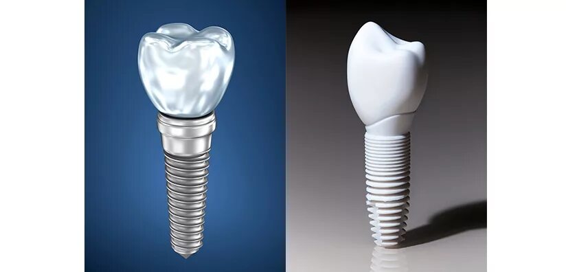 Titanium implants