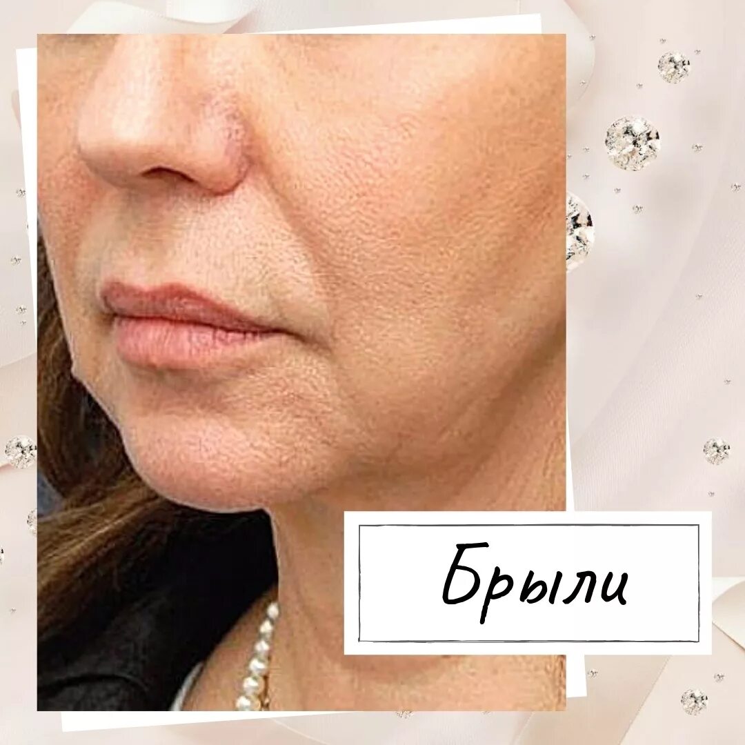 брыли. брыли на лице. оксана левина брыли. уколы от брылей на лице. причина брылей на лице.