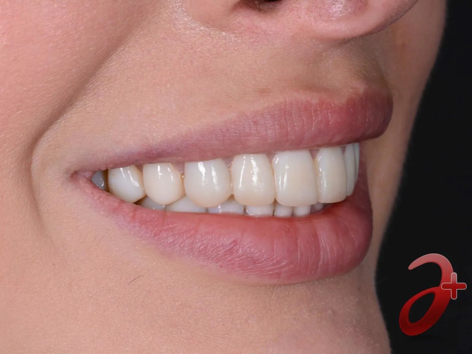 Коронки диоксид циркония а1. Коронки на передние зубы из диоксида циркония. Коронки из циркония. Диоксид циркония коронки. Металлокерамика и диоксид циркония.