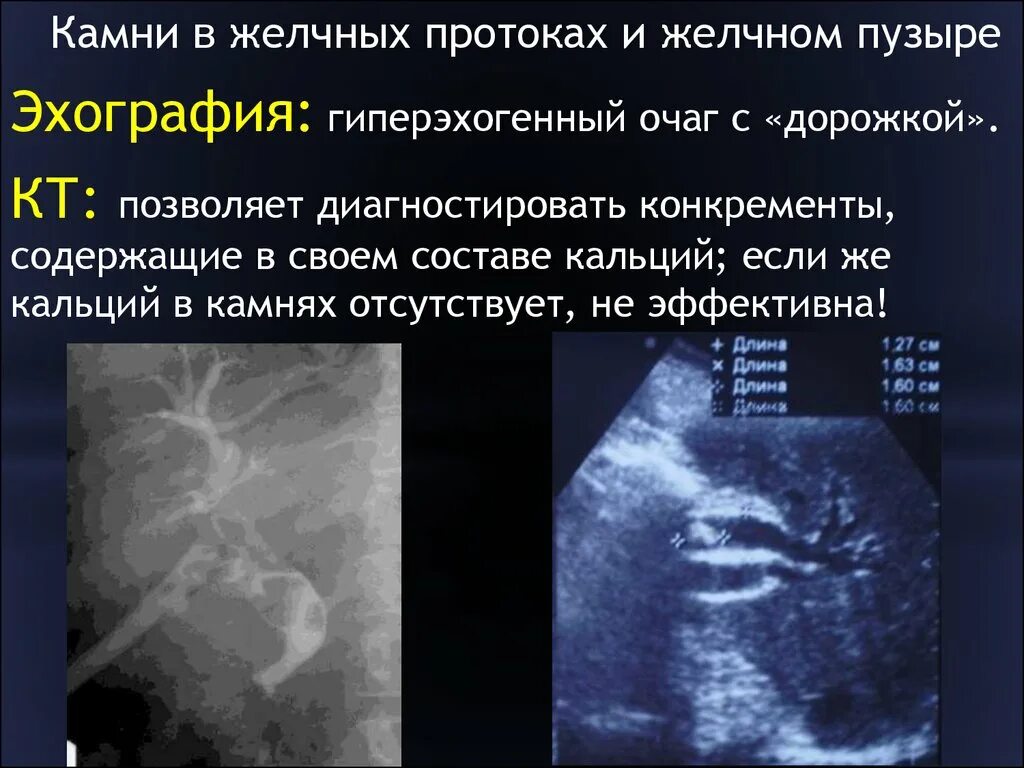 Конкремент в желчном протоке. Конкремент общего желчного протока. Камни в желчном пузыре УЗИ.