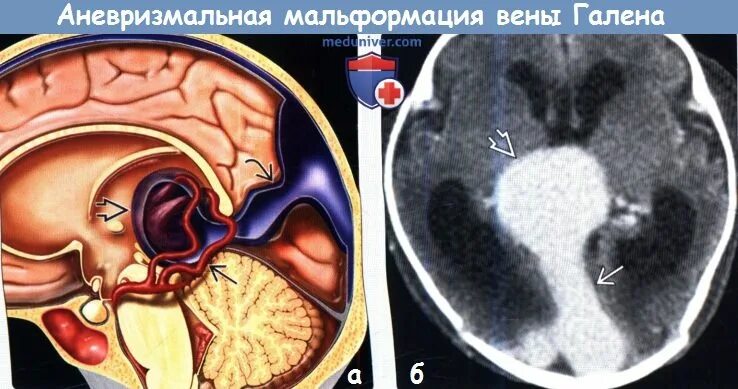 Аневризма перегородки у ребенка. Артериовенозная мальформация вены Галена. Расширение цистерны вены Галена. Мальформация вены Галена кт. Артериовенозная аневризма вены Галена.