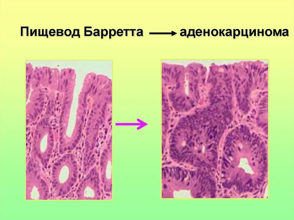 Пищевод баретта. Пищевод Барретта метаплазия эпителия. Пищевод Барретта (с 1 m2).. Аденокарцинома пищевода гистология. Гистология пищевода Баррета.