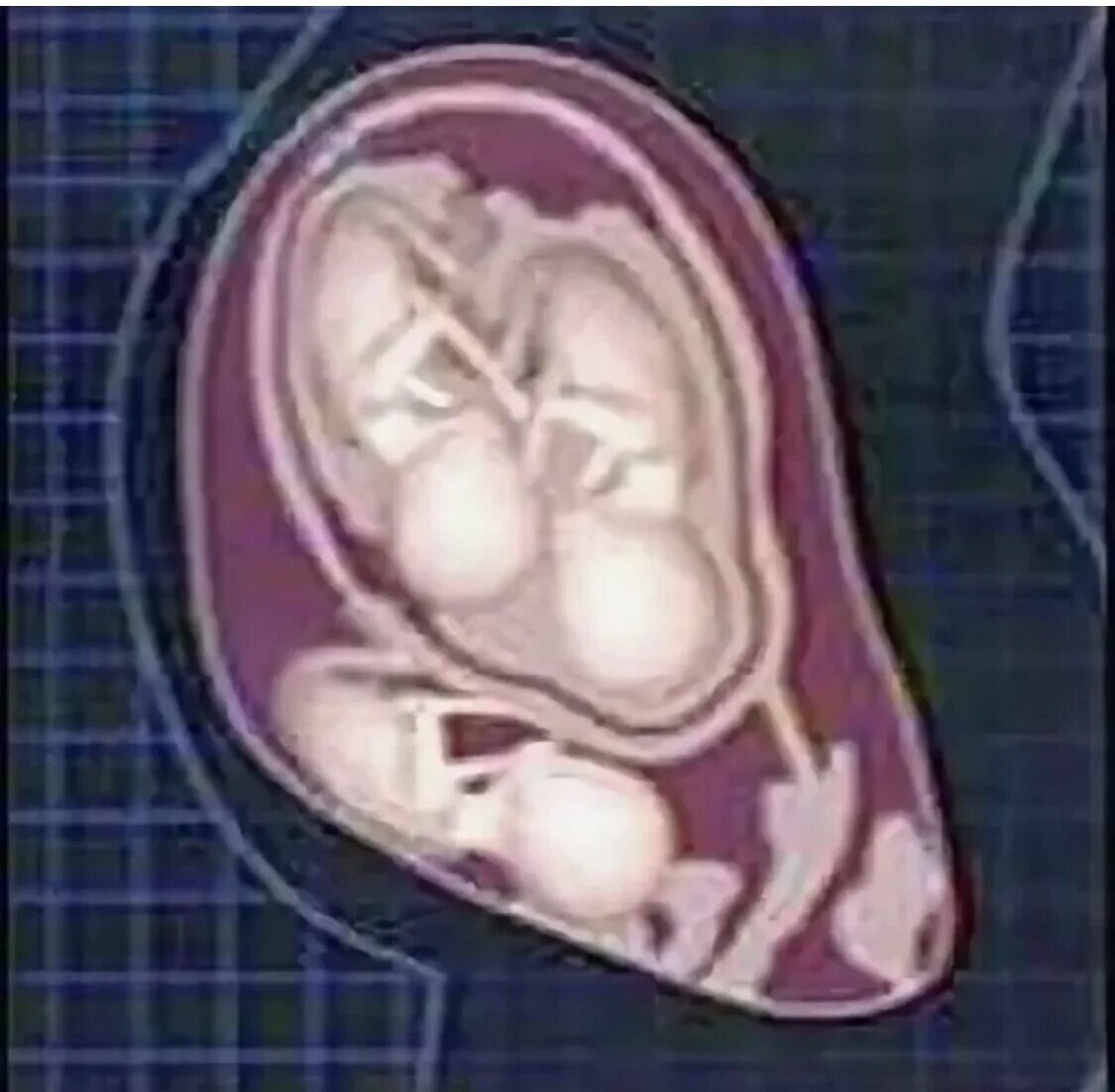 Близнецы 24 недели. Многоплодная беременность. Расположение двойни в животе.