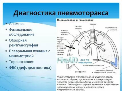 Дифференциальная диагностика пневмоторакса