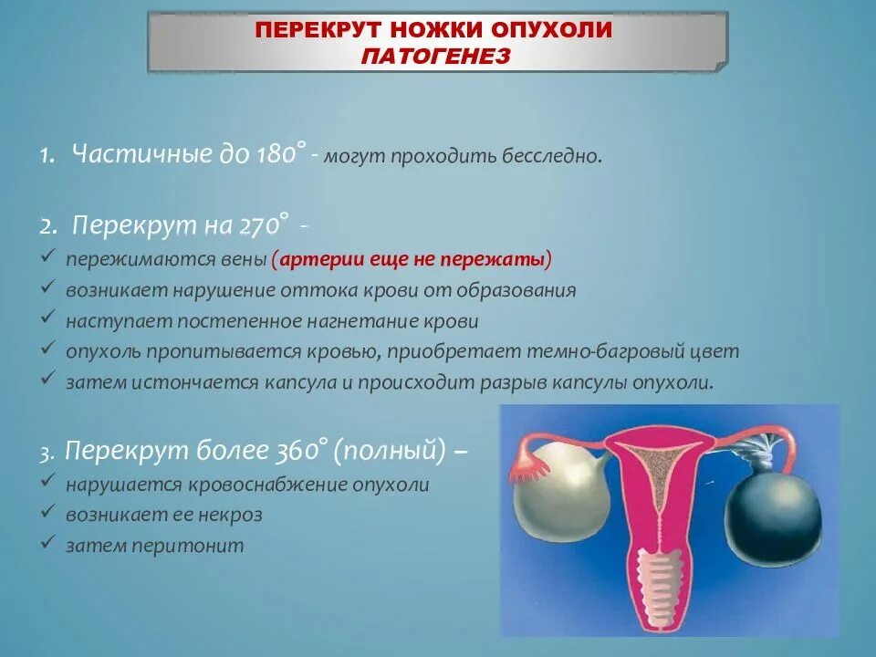 Какая матка при воспалении. Перекрут кисты яичников. Перекрут ножки кисты яичника. Перекрут кисты яичника классификация. Перекрут ножки опухоли яичника.