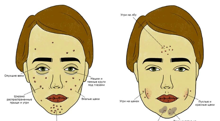 Типы угревой сыпи на лице. Прыщи на правой стороне лица. Зоны появления прыщей на лице. Прыщ на правой стороне примета