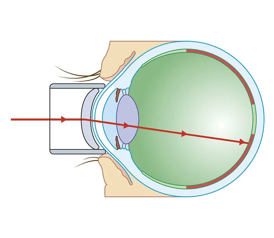 Лазерная коагуляция сетчатки глаза. Лазерной коагуляции сосудов сетчатки. Спайка сетчатки лазером. Периферическая лазеркоагуляция сетчатки глаза.