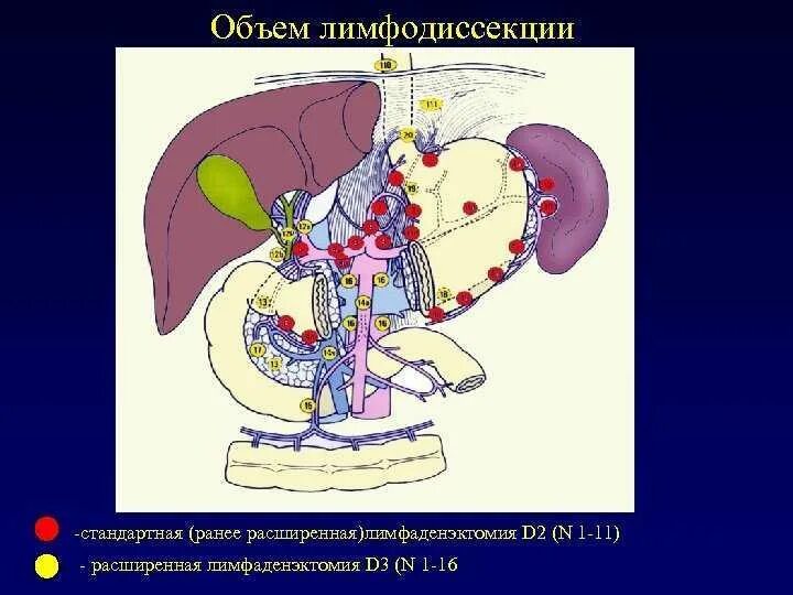 Лимфаденэктомия это. Лимфодиссекция d1 d2 d3. Лимфодиссекция желудка. Объемы лимфодиссекции. Гастрэктомия лимфодиссекция d2.