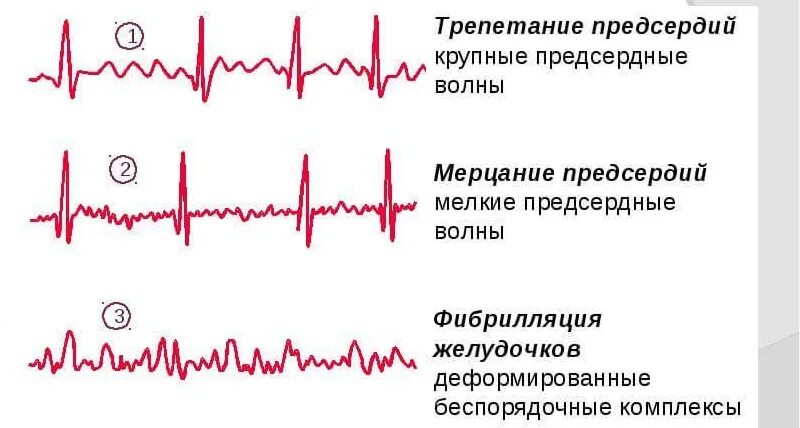 Какое давление при аритмии сердца. Трепетание и фибрилляция предсердий на экг. фибрилляция предсердий на экг. экг аритмии фибрилляция. пароксизмальная фибрилляция предсердий на экг.
