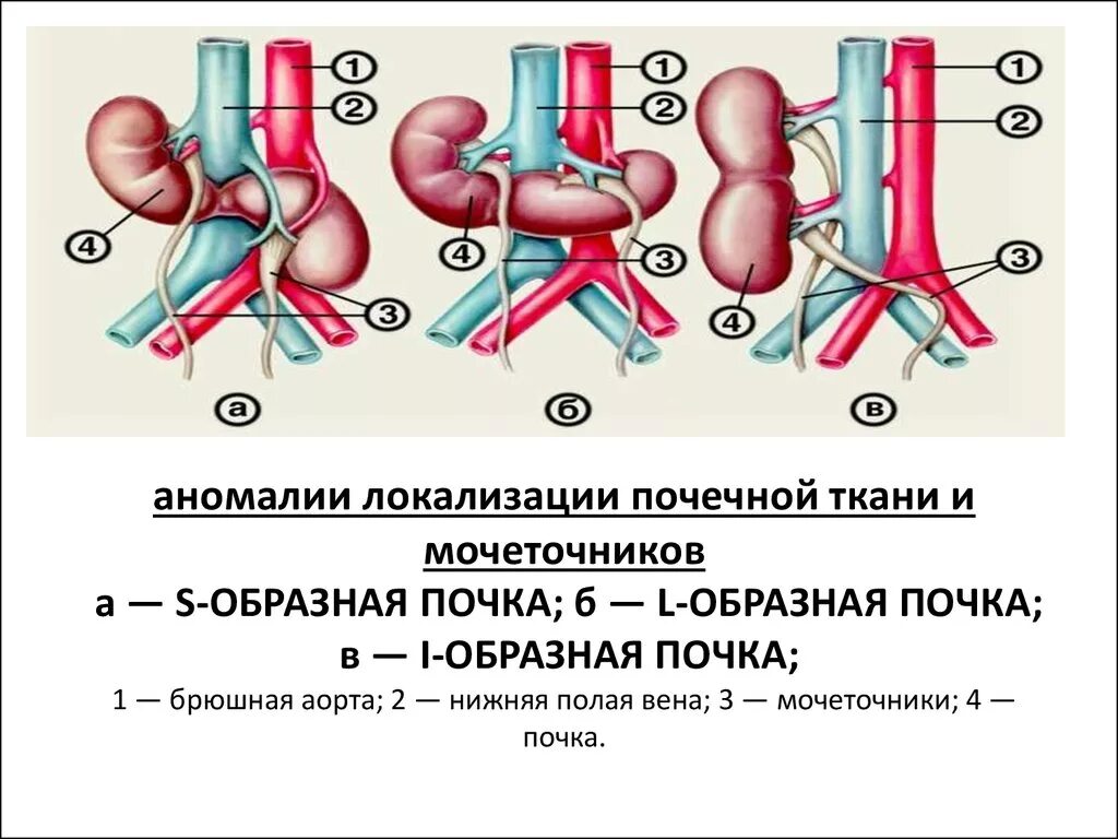 Вена артерия мочеточник. Аномалии развития почек дистопия. Аномалии развития почечных сосудов. Операции при врожденных пороках развития почек. Классификация врожденный аномалия почек.