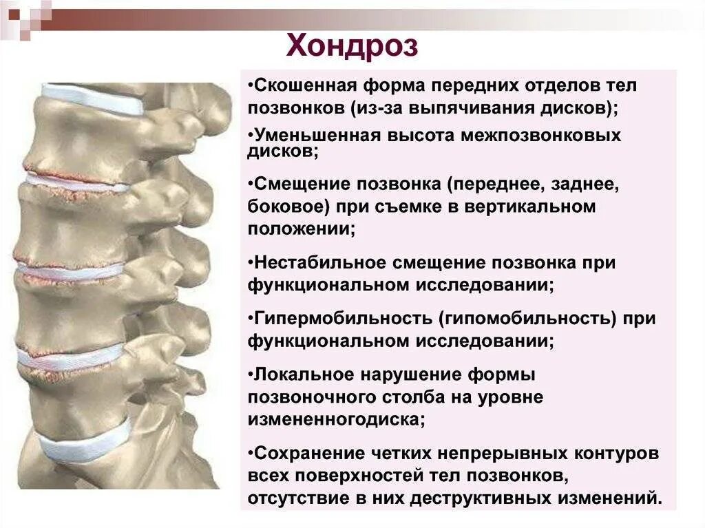 Как лечить поясничного отдела позвоночника. Остеохондроз поясничного отдела. Остеохондроз грудного отдела. Остеохондроз грудного и поясничного отдела.