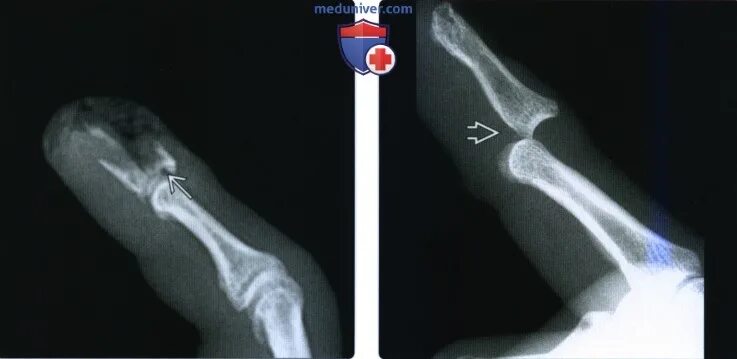 Открытый перелом фаланги. Перелом фаланги мизинца рентген. Подвывих фаланги пальца руки рентген. Перелом ногтевой фаланги рентген. Вывих мизинца на руке рентген.
