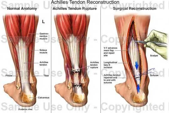 Ахиллово сухожилие где фото