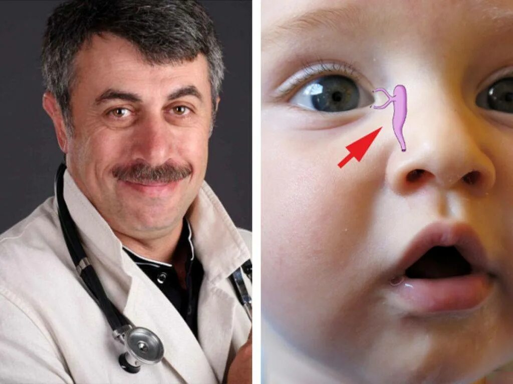 Массаж глаза у новорожденного. Дакриоцистит доктор Комаровский новорожденных. Массаж слезного канала у новорожденного. Засорение глазного канала.