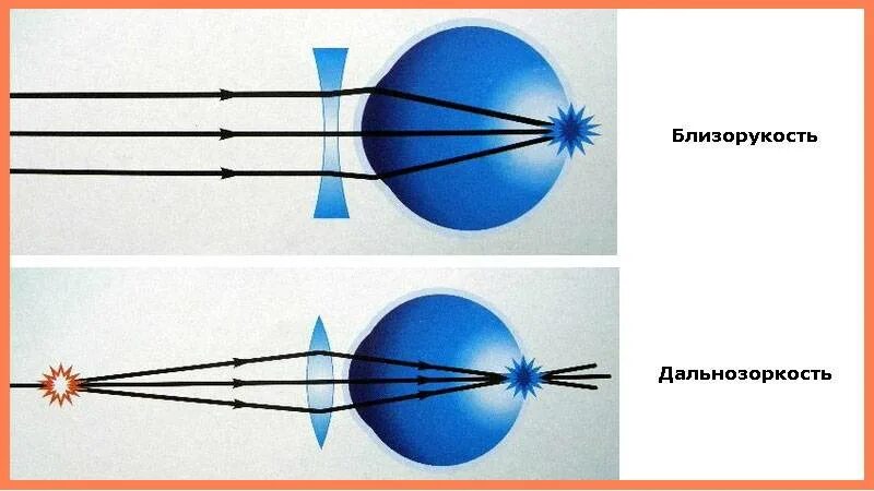 Коррекция зрения с помощью линз. Близорукость и дальнозоркость физика. Коррекция зрения близорукость и дальнозоркость. Дефекты зрения дальнозоркость. Коррекция миопии и гиперметропии.