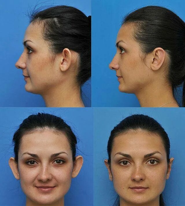 пластика ушей как называется. ушная раковина лопоухость. пластика ушей как называется. пластика на уши лопоухость. исправление лопоухости.