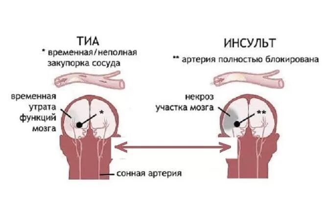 Высокое давление атака. Транзиторная ишемическая атака головного мозга симптомы. транзиторный ишемический инсульт симптом. транзиторная ишемическая атака после инсульта. отличие ишемического инсульта и тиа.
