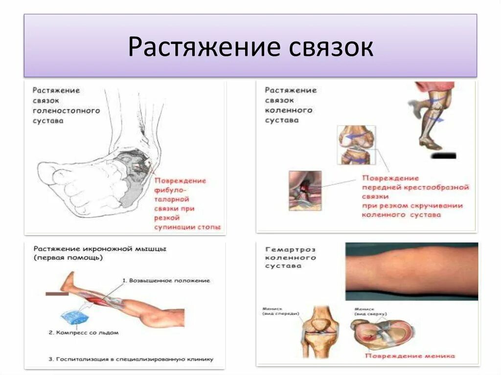 Что делать при растяжении связок колена