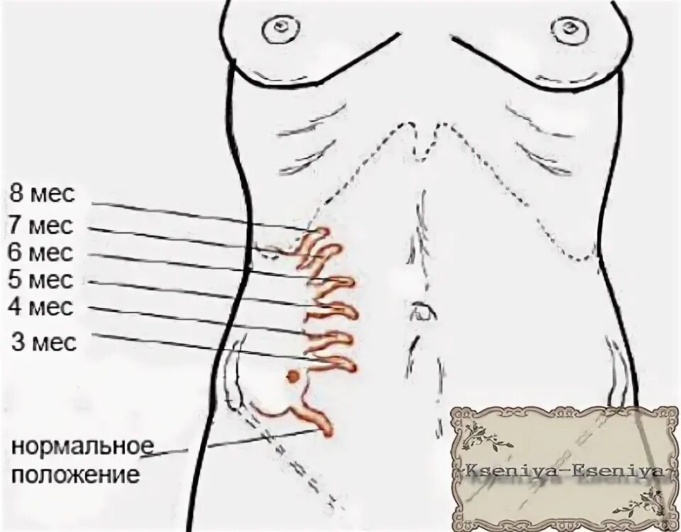 Раздражение брюшины при аппендиците