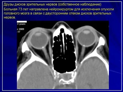 Друзы диска зрительного нерва