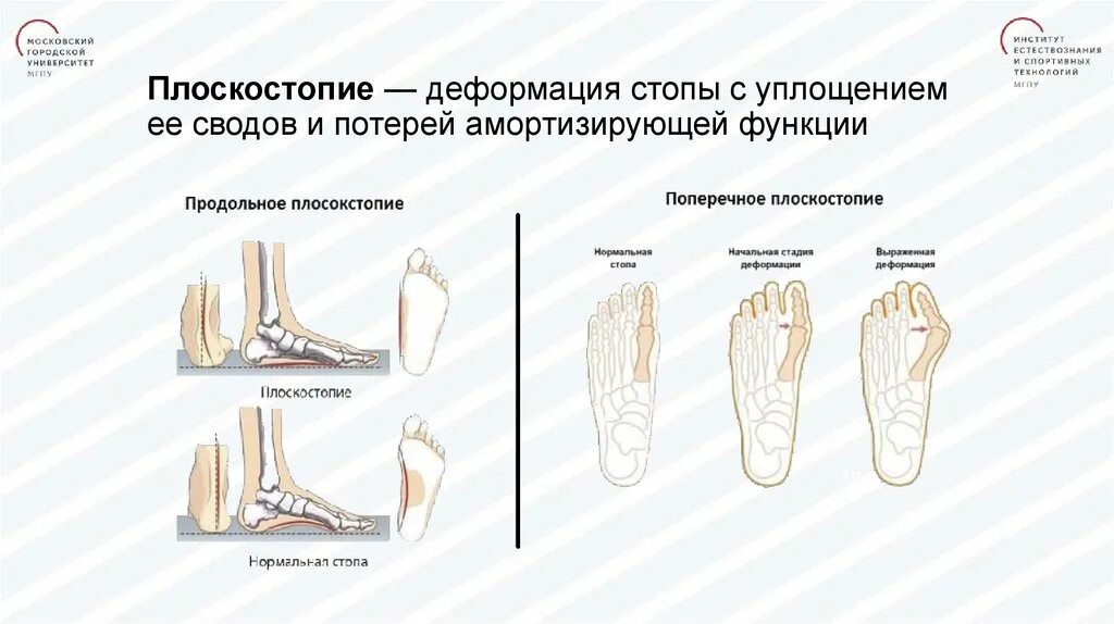 Что рекомендовано для снижения продольно динамических. Упражнения для развития свода стопы. плоскостопие деформация стопы характеризующаяся уплощением. патогенез плоскостопия. продольно -поперечное плоскостопие стопы.