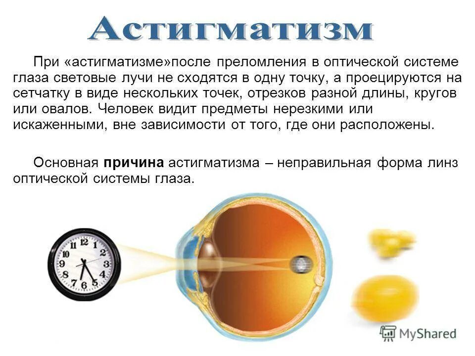 Астигматизм. Гиперметропический астигматизм. Гиперметропический астигматизм у детей. Сложный миопический астигматизм