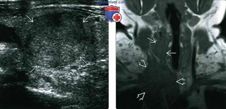 Медулярный рак. Медуллярная опухоль щитовидной железы УЗИ. Карцинома щитовидной железы на кт. Опухоль щитовидной железы мрт. Образование щитовидной железы на кт.
