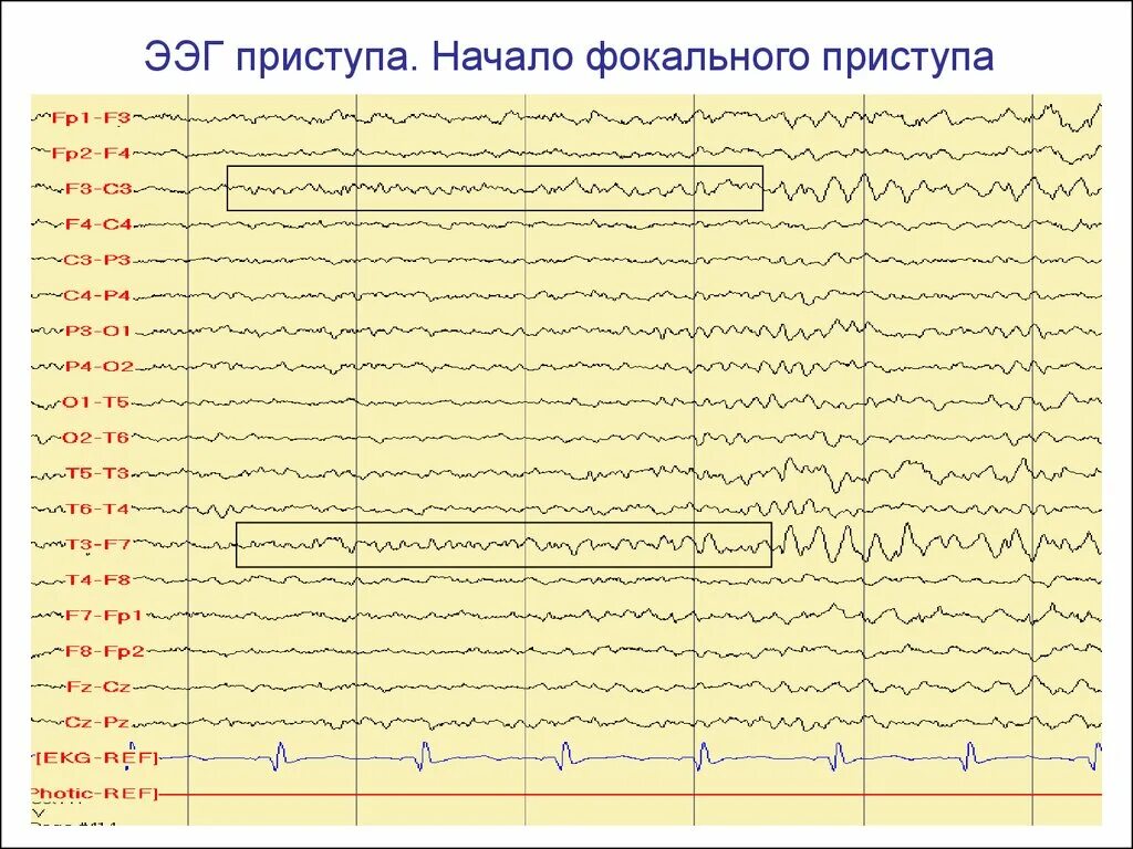 Эпи ээг. Эпилептиформная активность на ЭЭГ. Приступ эпилепсии на ЭЭГ. ЭЭГ головного мозга эпилепсии. ЭЭГ головного мозга больного эпилепсией.