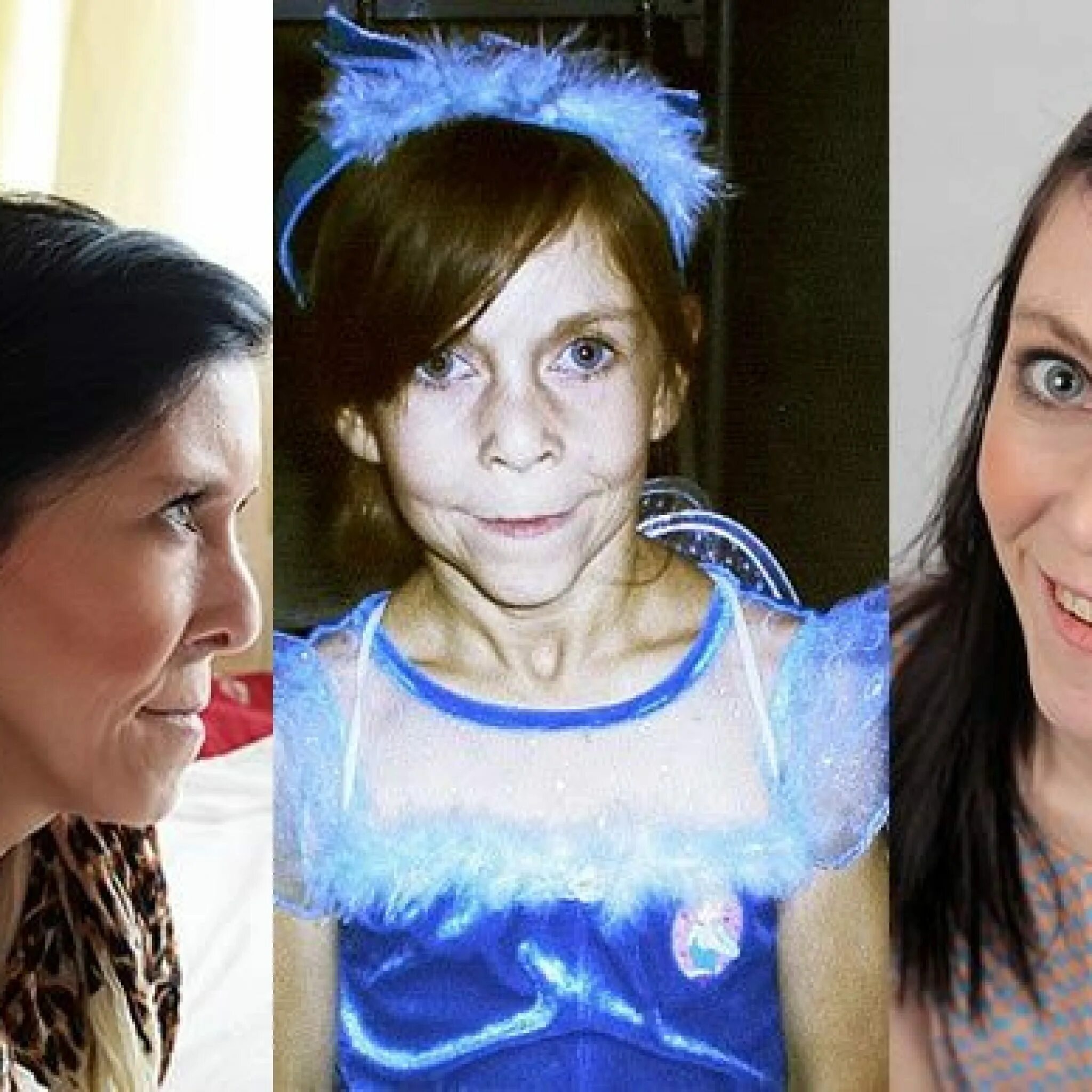 прогерия хатчинсона-гилфорда. синдром гетчинсона (хатчинсона) — гилфорда. прогерия синдром хатчинсона. синдром преждевременного старения. прогерия хатчинсона-гилфорда.