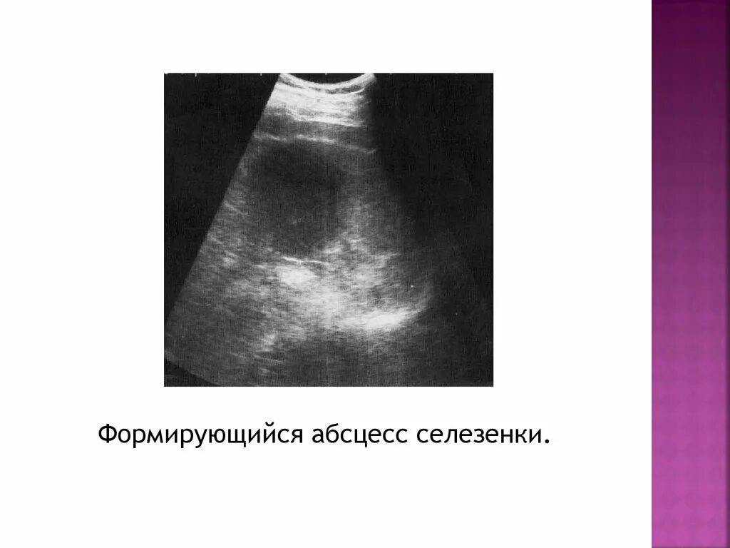 Абсцесс селезенки эхограмма. Пиогенный абсцесс селезенки. Распад селезенки