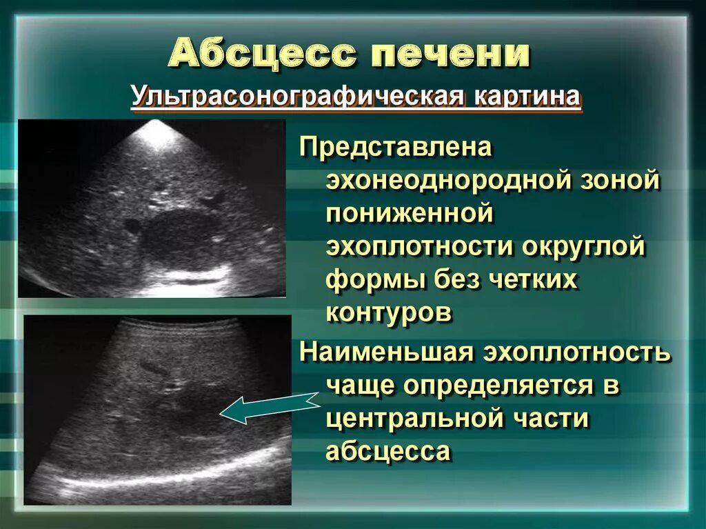 Кисты печени симптомы причины. Холангиогенный абсцесс печени. Объемные образования печени на УЗИ.