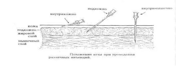 Внутрикожная глубина введения иглы. Внутрикожная инъекция угол введения иглы. Угол наклона иглы для подкожной инъекции. Угол введения иглы при внутрикожной инъекции. Уголь введения иглы при внутривенной инъекции.